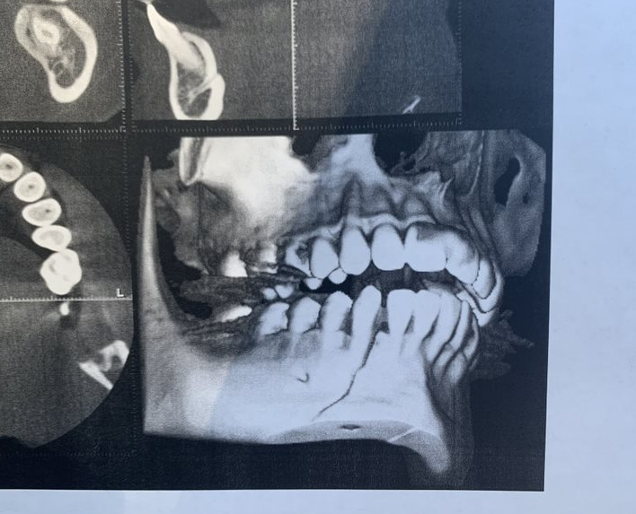 Senior Kaitlyn Clarks X-ray of her jaw before it had to be wired shut. 
